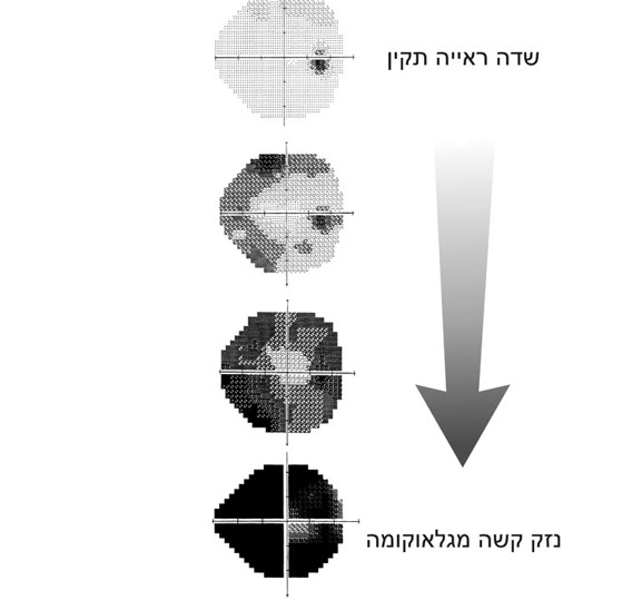 ארבע תמונות ובהן שלבי צמצום שדה הראייה