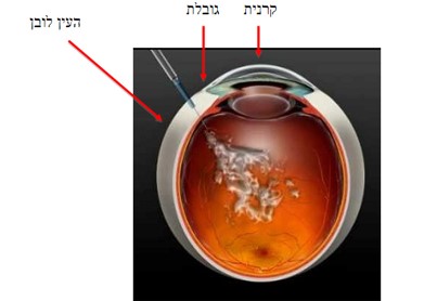 הזרקת הורמון לתוך העין